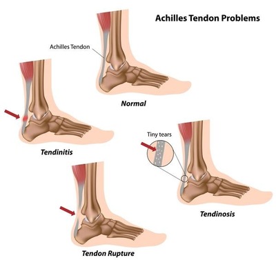 posterior heel pain