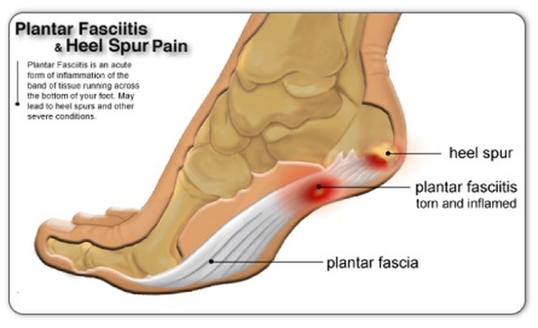 posterior lateral heel pain